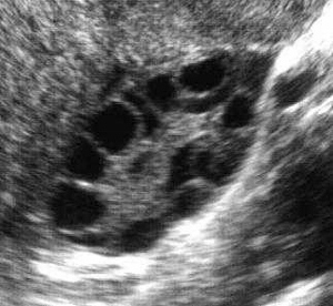 Gambar ultrasound ovari menunjukkan 'polycystic ovary'